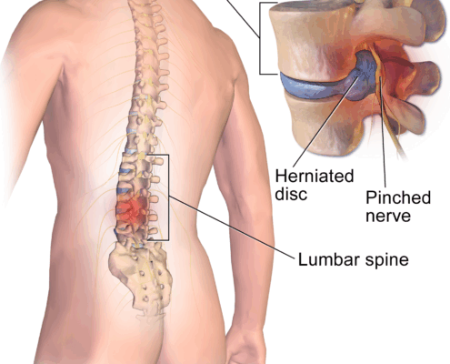 Blausen 0484 HerniatedLumbarDisc