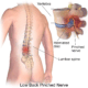 Blausen 0484 HerniatedLumbarDisc